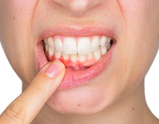 Diş Eti Tedavileri (Periodontoloji)