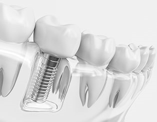 Diş Implantı